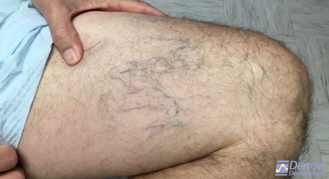 Spider-Veins-Case-A-before rev