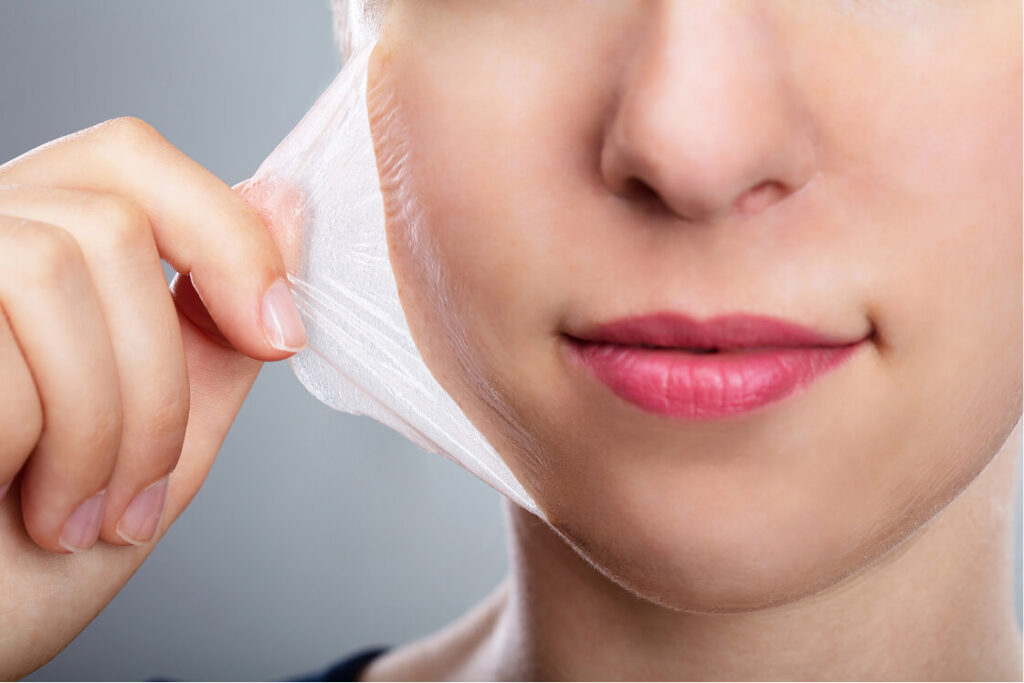How Long Does It Really Take for a Chemical Peel to Heal?