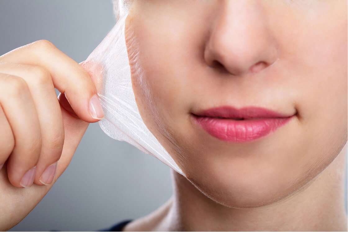 How Long Does It Really Take for a Chemical Peel to Heal?